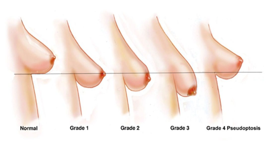 Breast-Grades