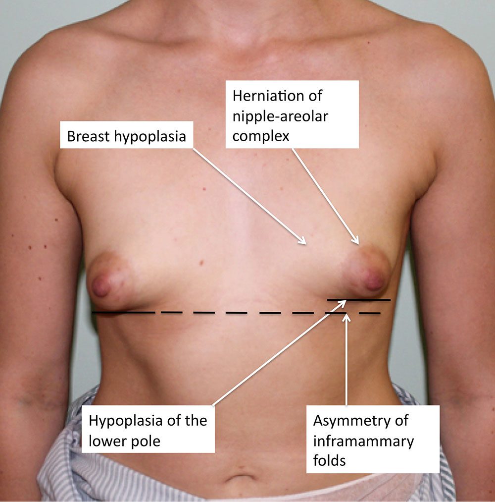 tuberous breast deformity