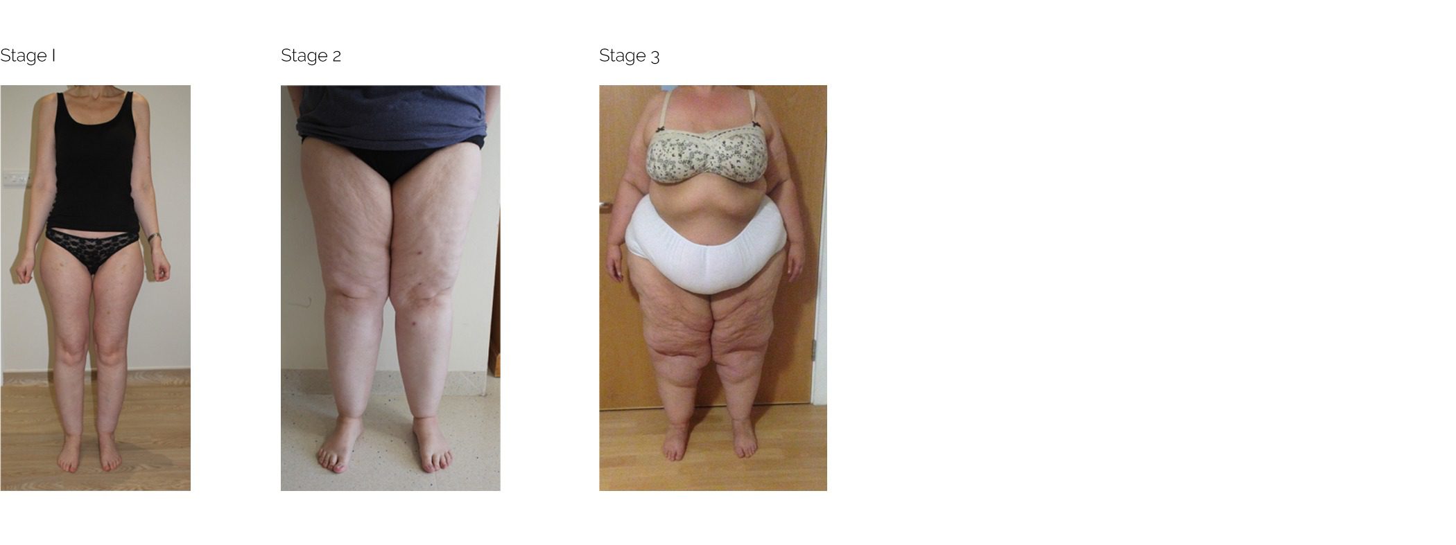 Lipoedema-Stages