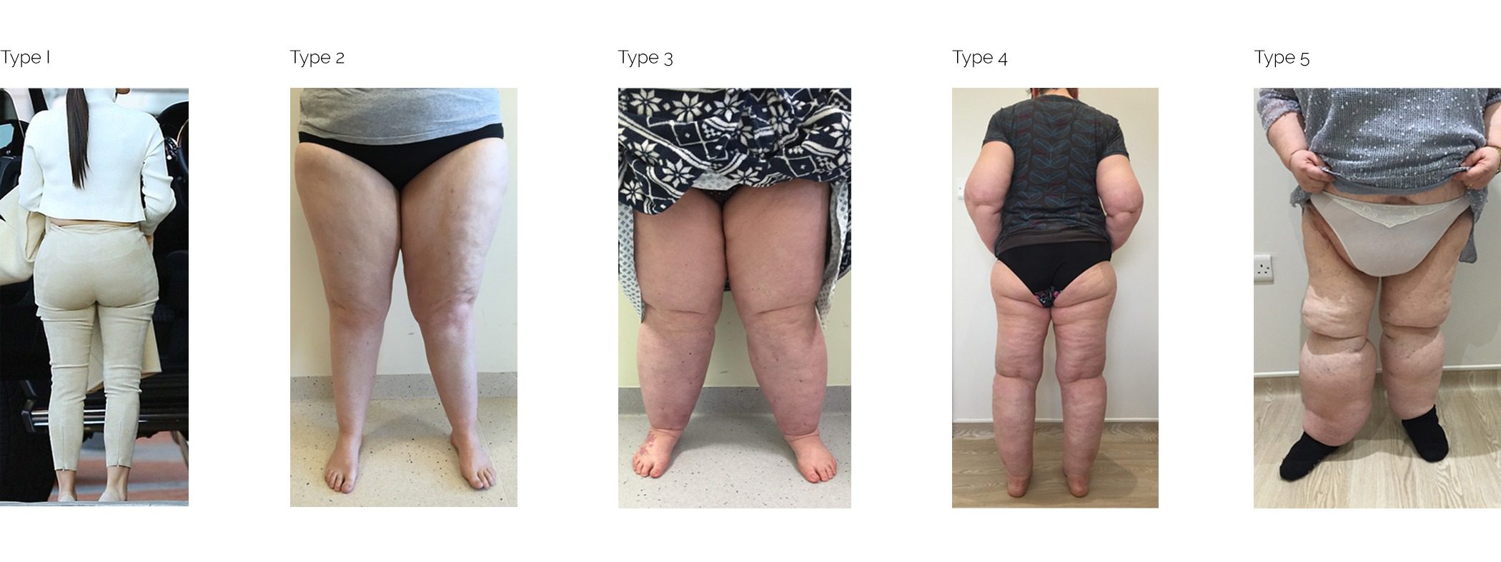 Lipoedema-Types3