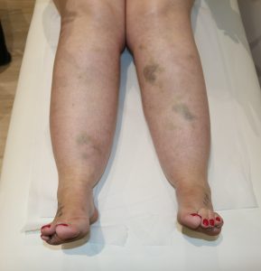 lipoedema bruising