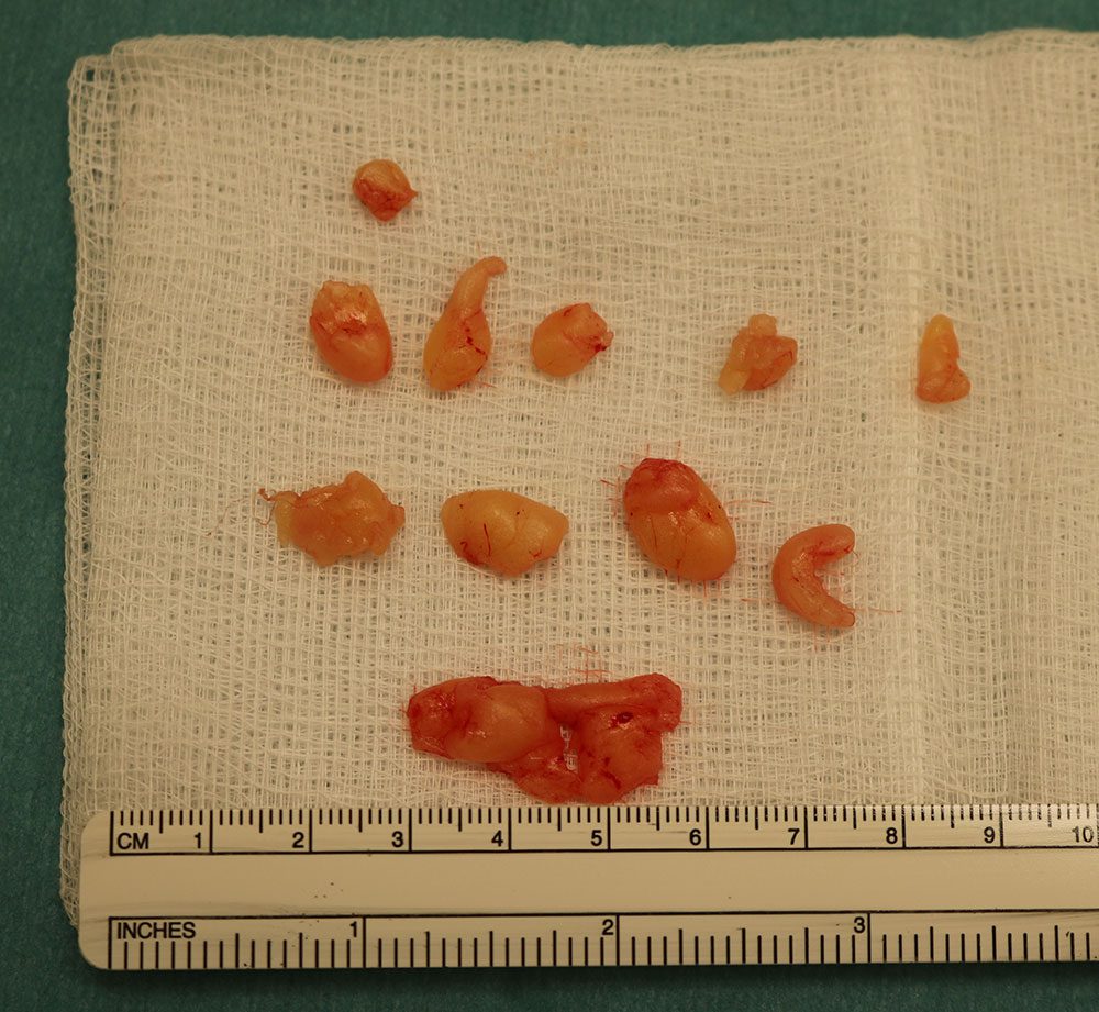 lipoedema nodular fat