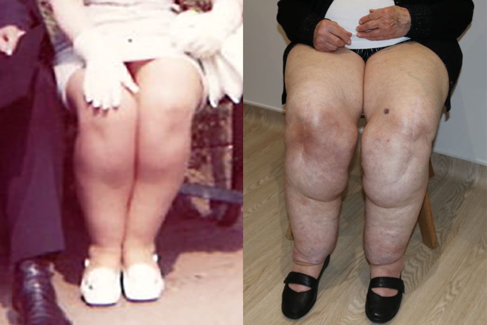 progressive nature of lipoedema