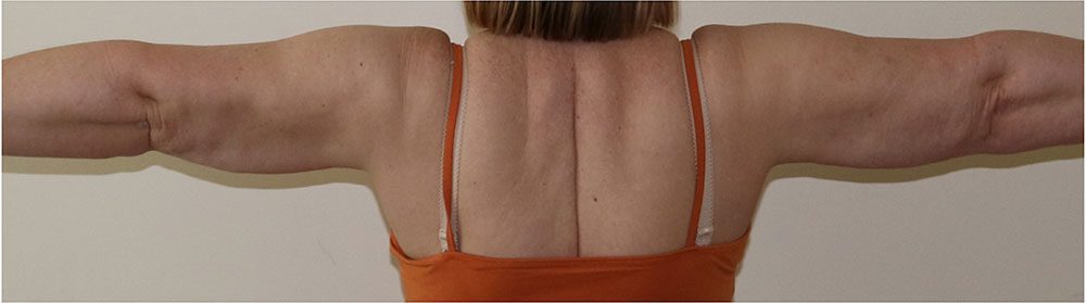 arm-liposuction-patient2-after-posterior-view