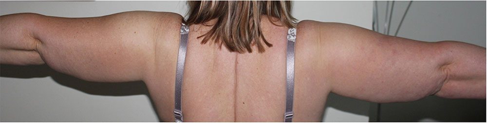Arm liposuction before surgery