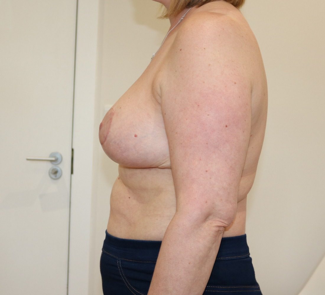 Breast reduction Wise pattern after left lateral