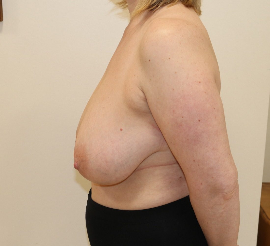 Breast reduction Wise pattern before left lateral
