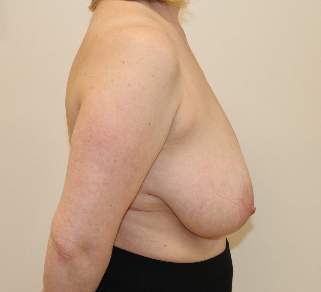 Breast reduction Wise pattern before right lateral