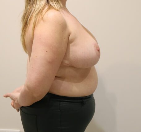 Breast reduction after right lateral