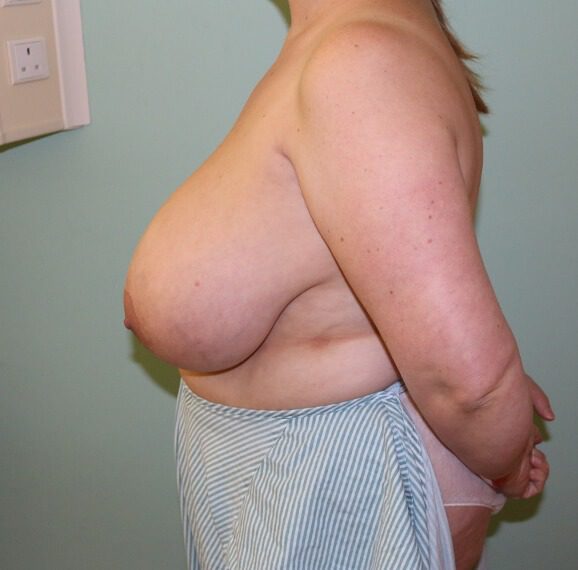 Breast reduction before left lateral