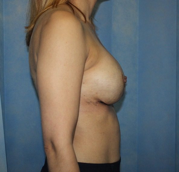Capsular contracture surgery after right lateral