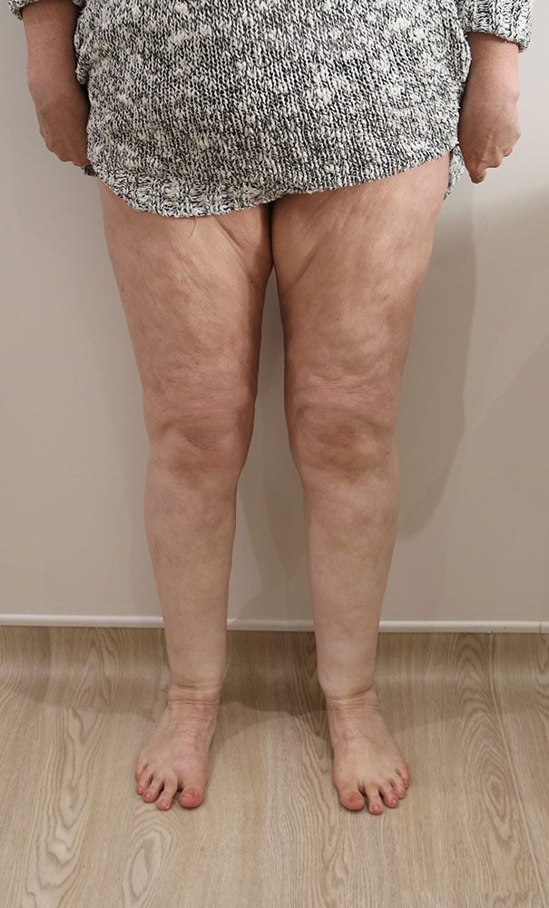 Lipoedema liposuction patient 1 after AP view