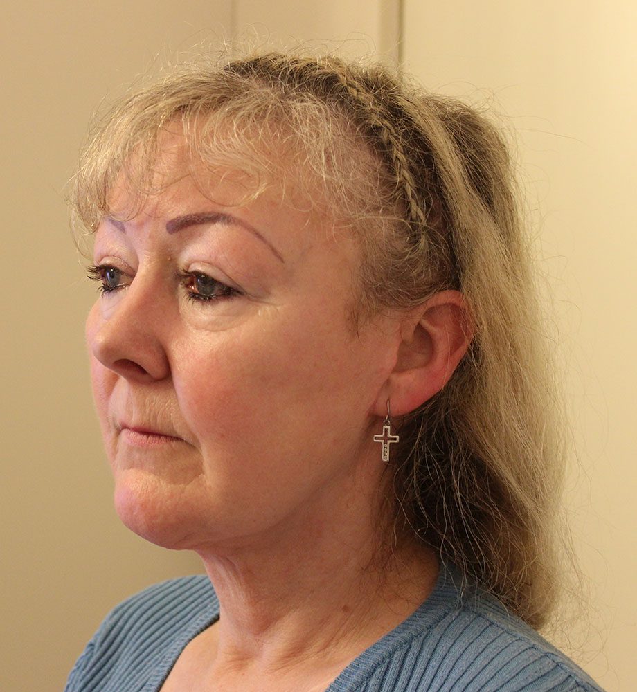 Necklift patient 2 after left oblique