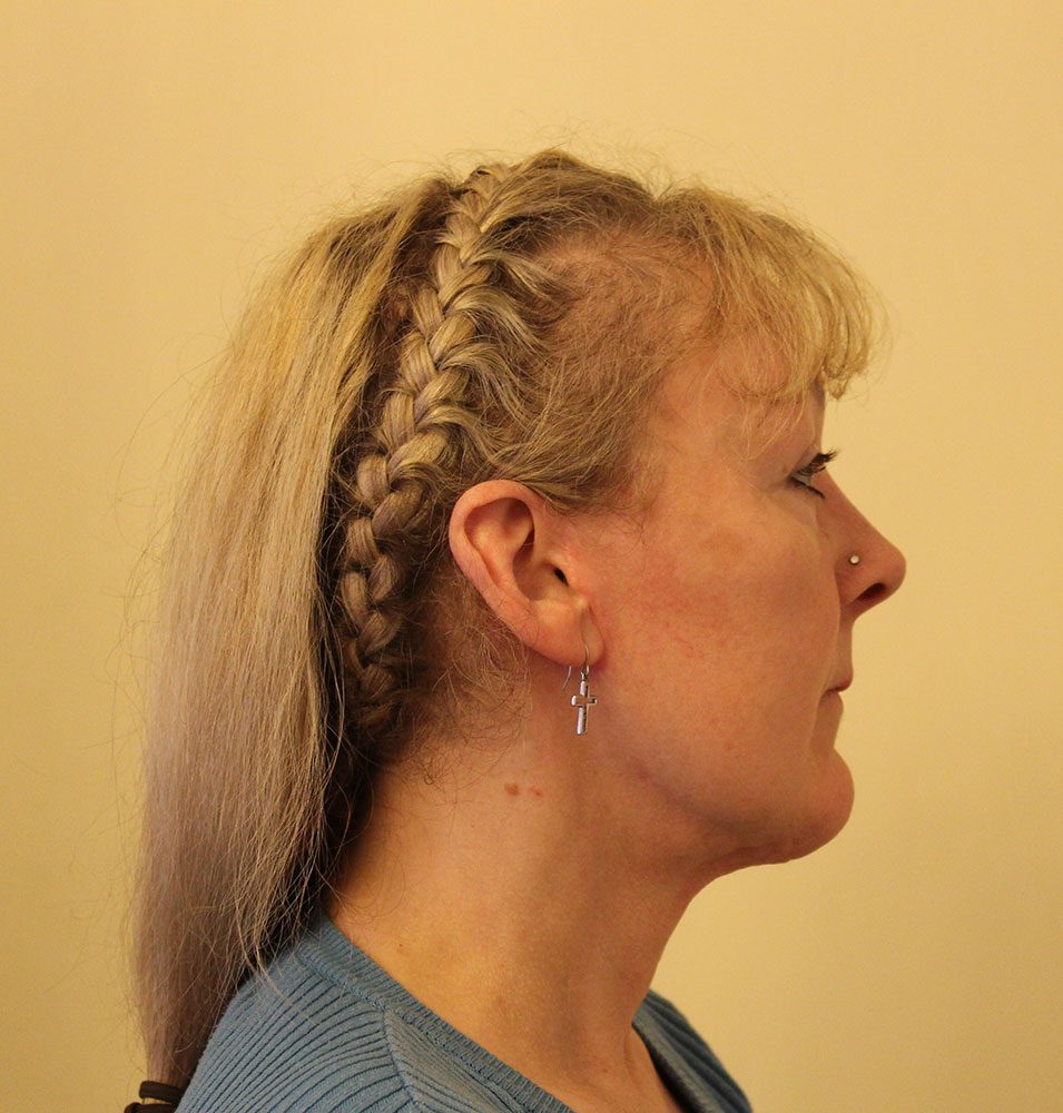 Necklift patient 2 after right lateral