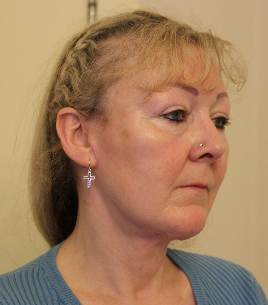 Necklift patient 2 after right oblique