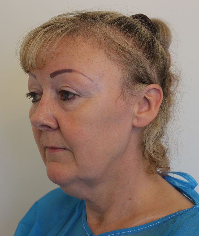 Necklift patient 2 before left oblique