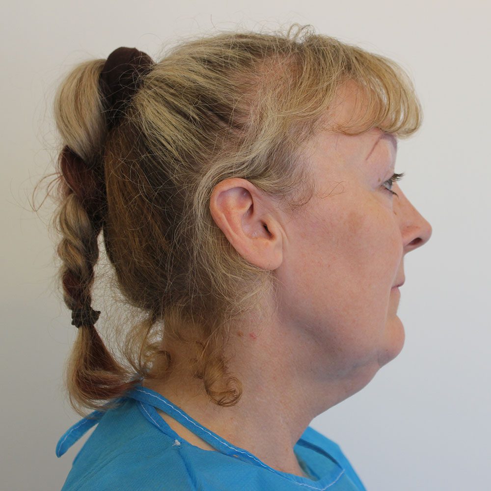 Necklift patient 2 before right lateral
