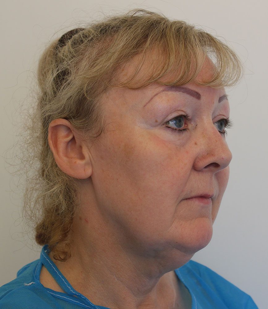 Necklift patient 2 before right oblique