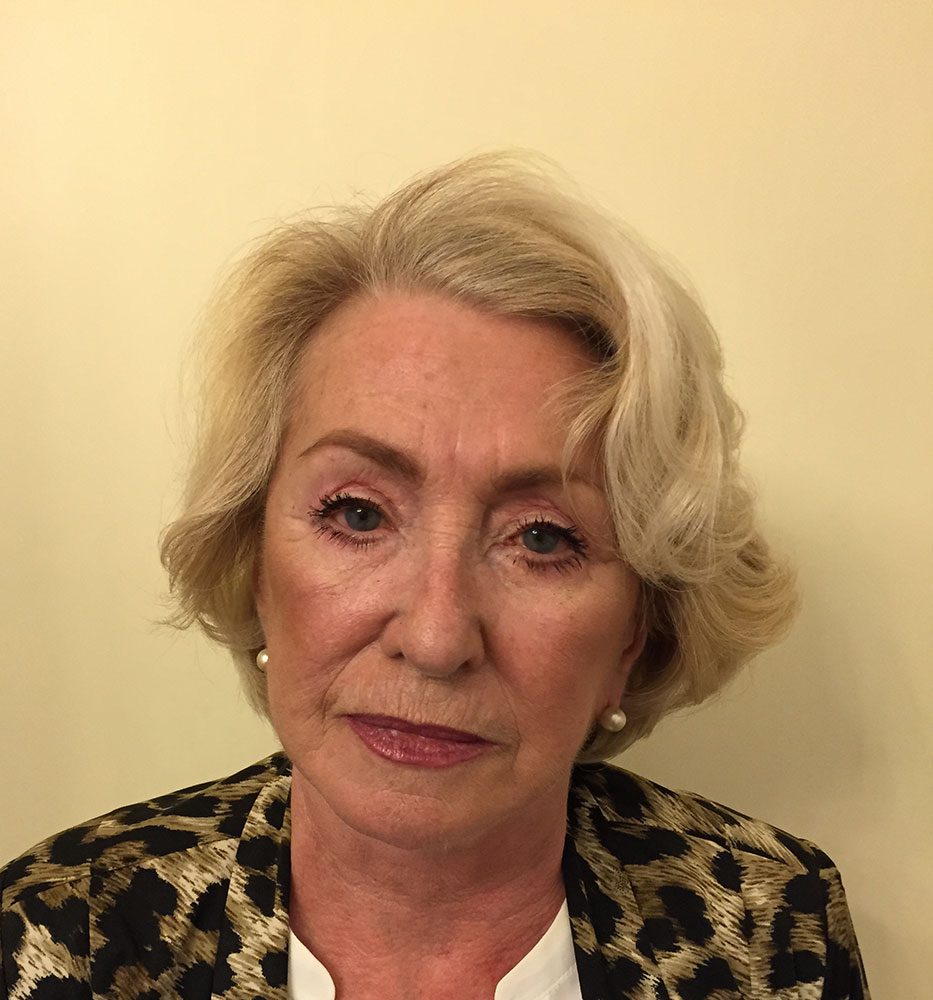 Redo short scar facelift patient 1 after AP view