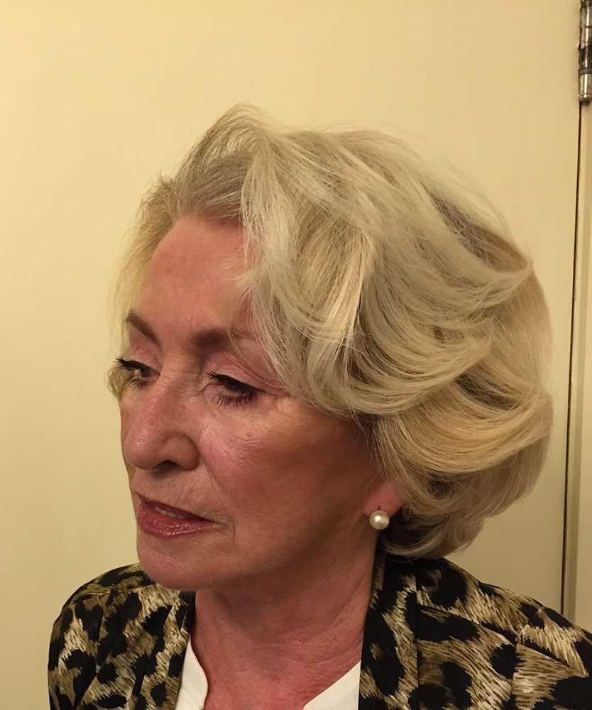 Redo short scar facelift patient 1 after left oblique