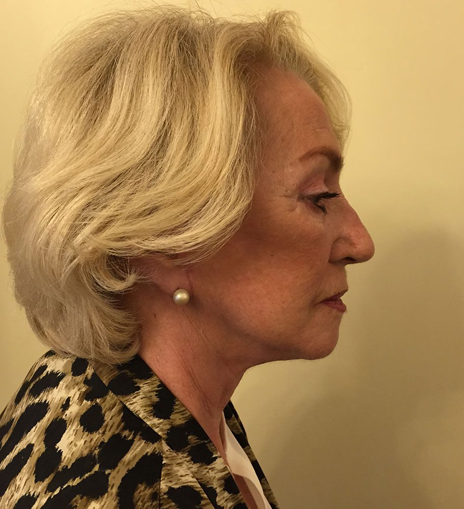 Redo short scar facelift patient 1 after right lateral