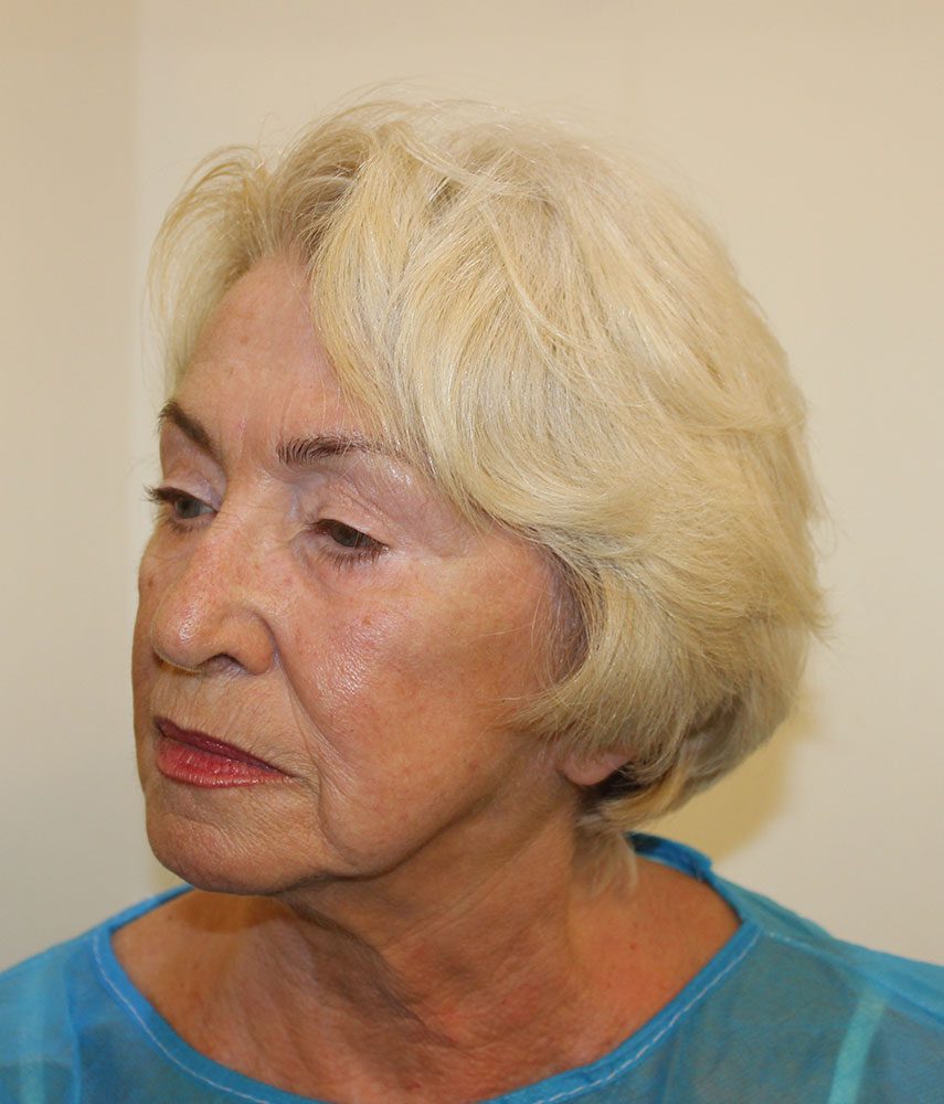 Redo short scar facelift patient 1 before left oblique