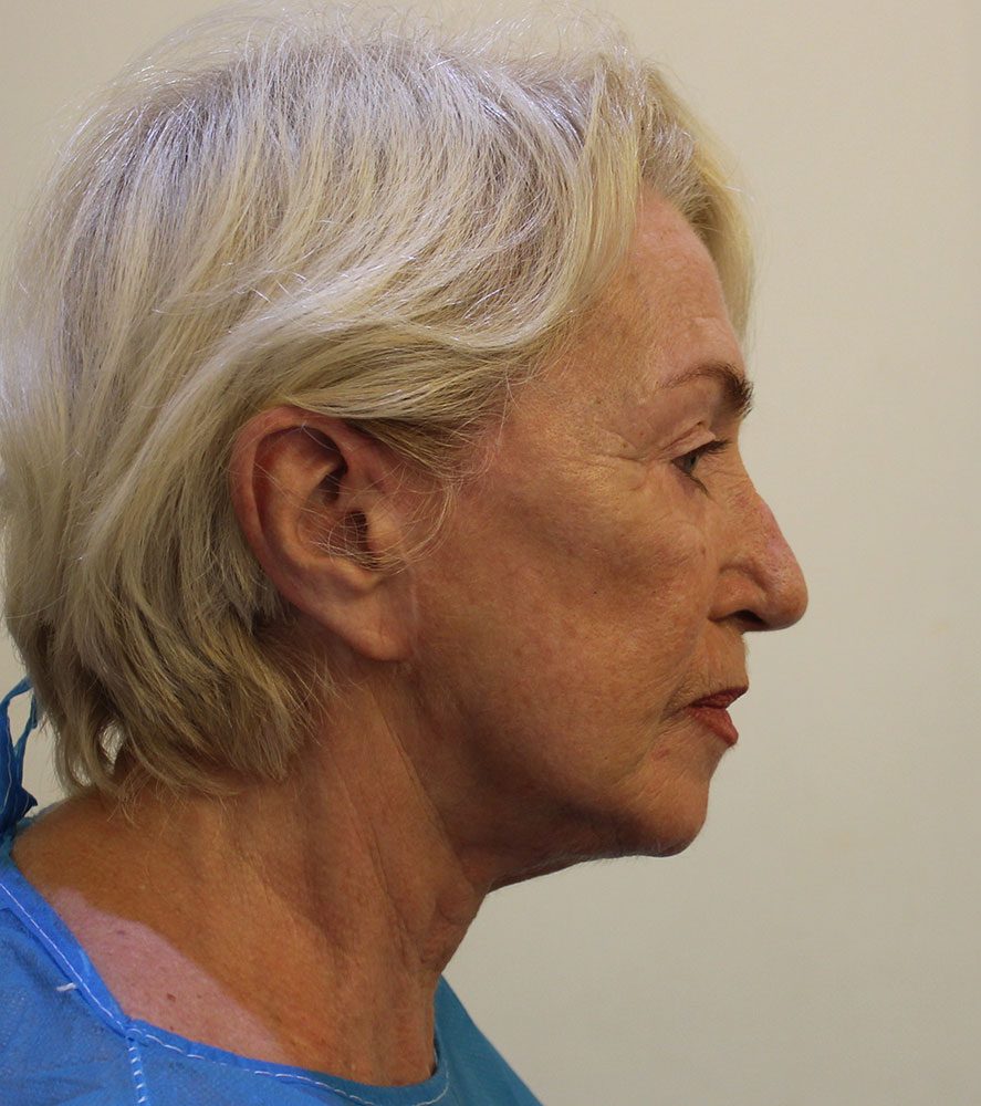 Redo short scar facelift patient 1 before right lateral