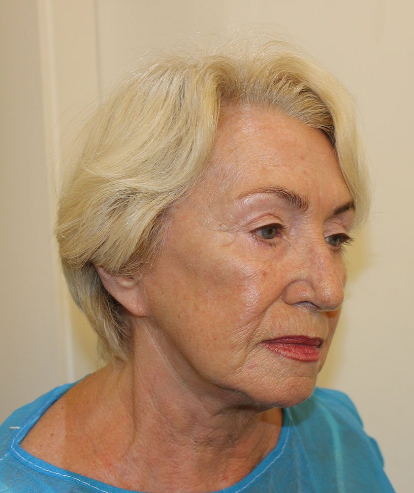 Redo short scar facelift patient 1 before right oblique