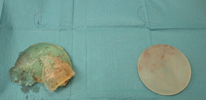 Ruptured breast implant