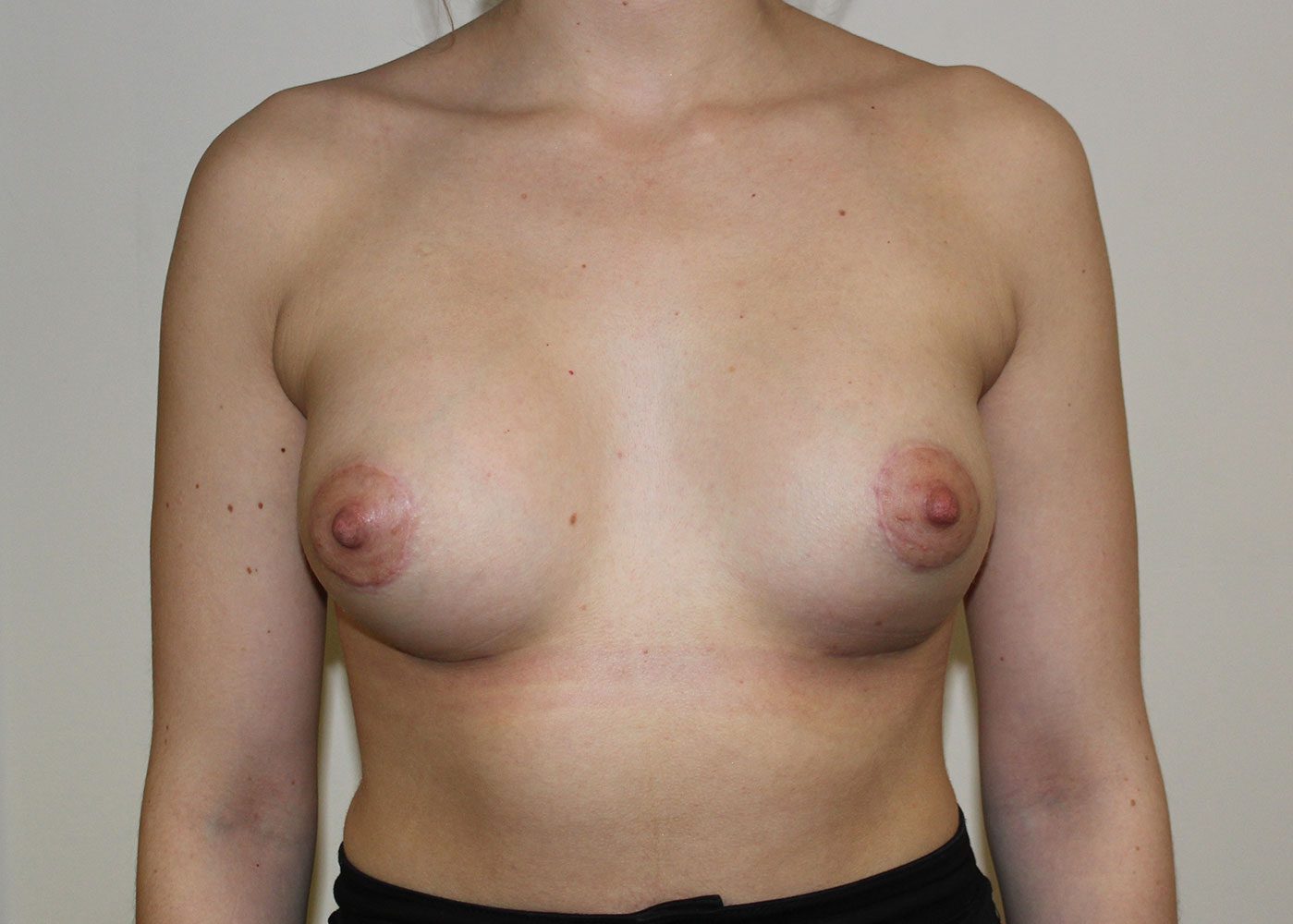 Tuberous breast correction patient 1 after AP view
