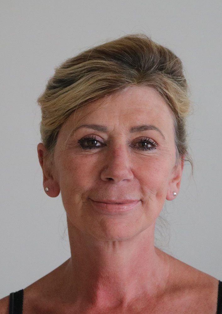 facelift necklift upper blepharoplasty patient 1 after AP view