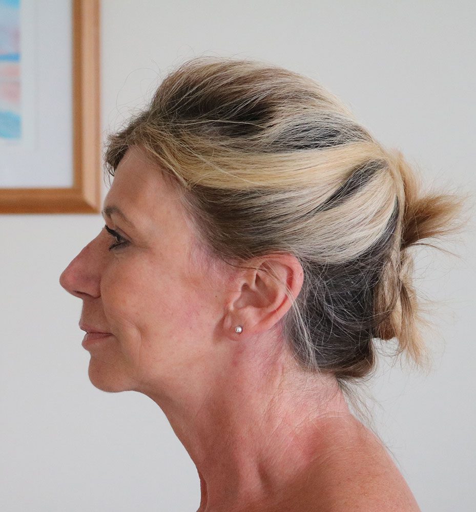 facelift necklift upper blepharoplasty patient 1 after leftlateral