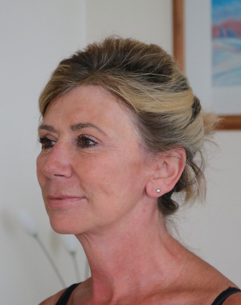 facelift necklift upper blepharoplasty patient 1 after leftoblique