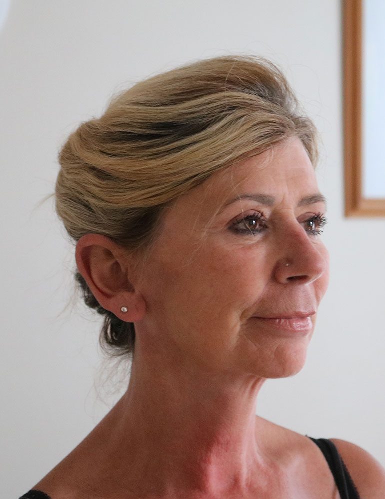 facelift necklift upper blepharoplasty patient 1 after rightoblique