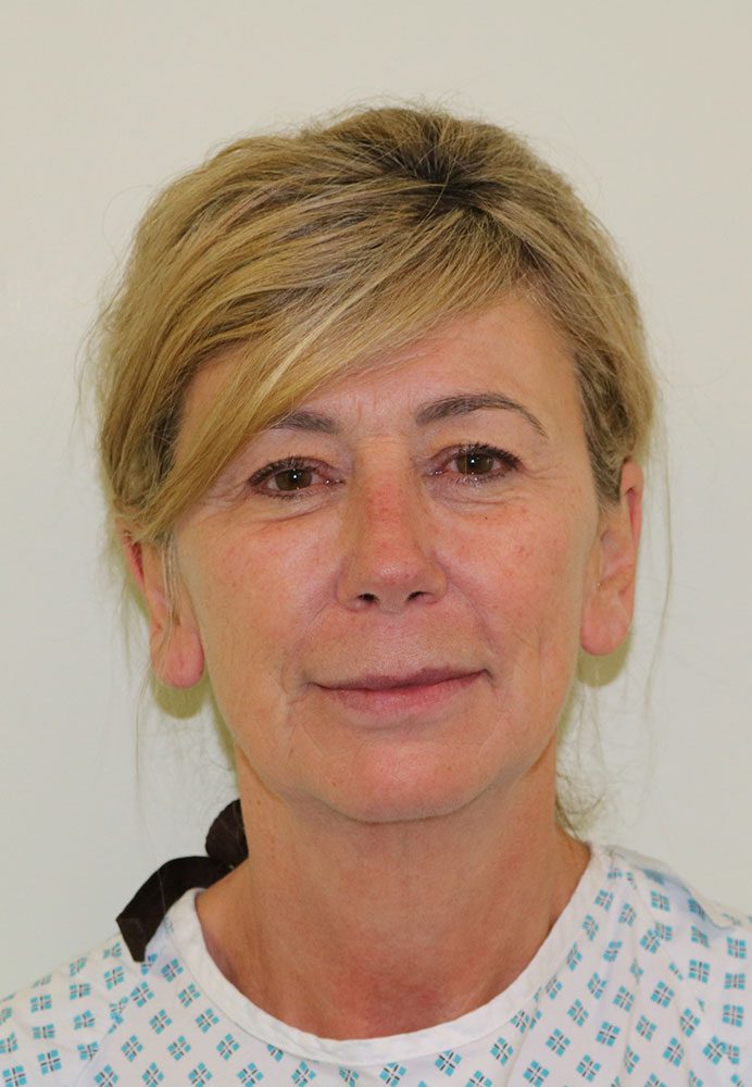 facelift necklift upper blepharoplasty patient 1 before AP view