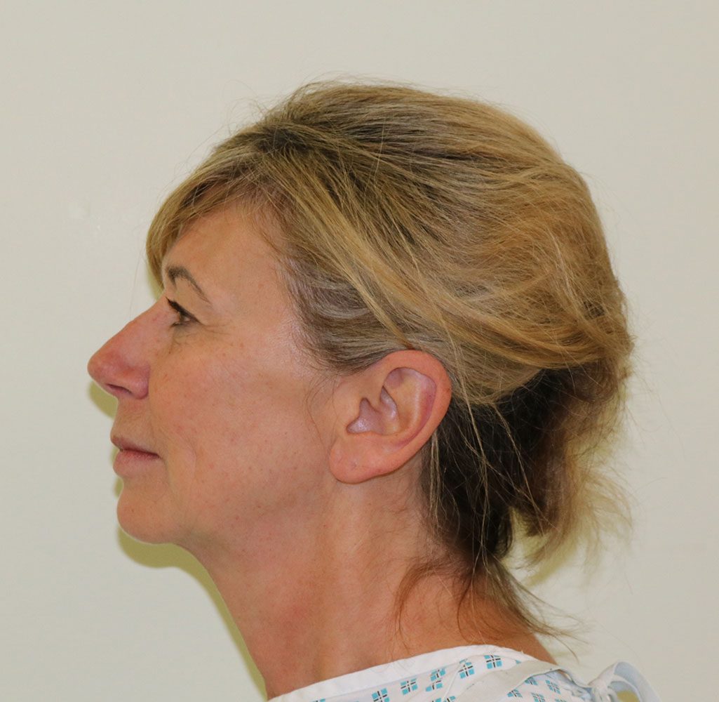 facelift necklift upper blepharoplasty patient 1 before leftlateral