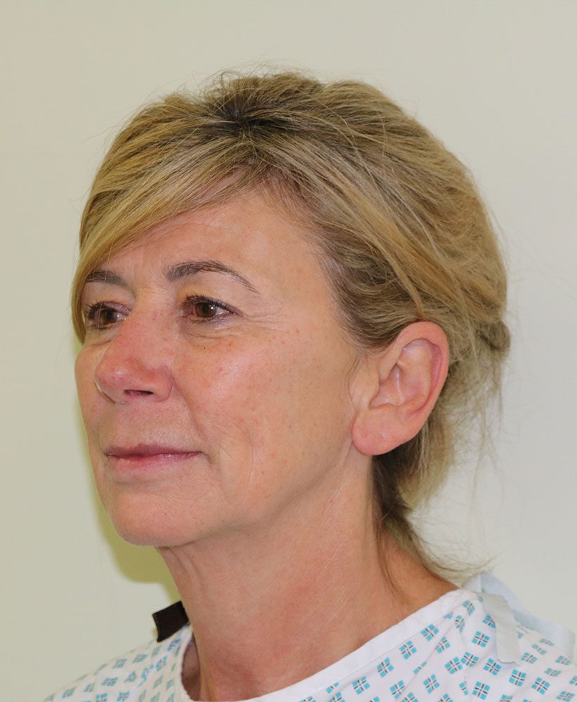 facelift necklift upper blepharoplasty patient 1 before leftoblique