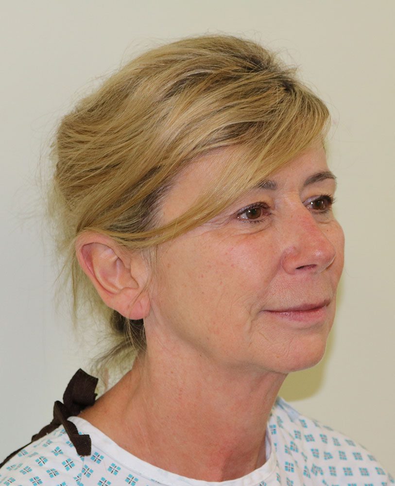 facelift necklift upper blepharoplasty patient 1 before rightoblique