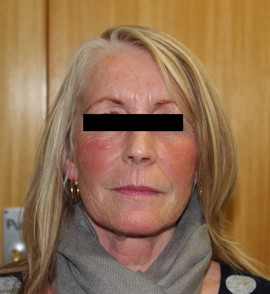 facial fat grafting patient 2 after AP view