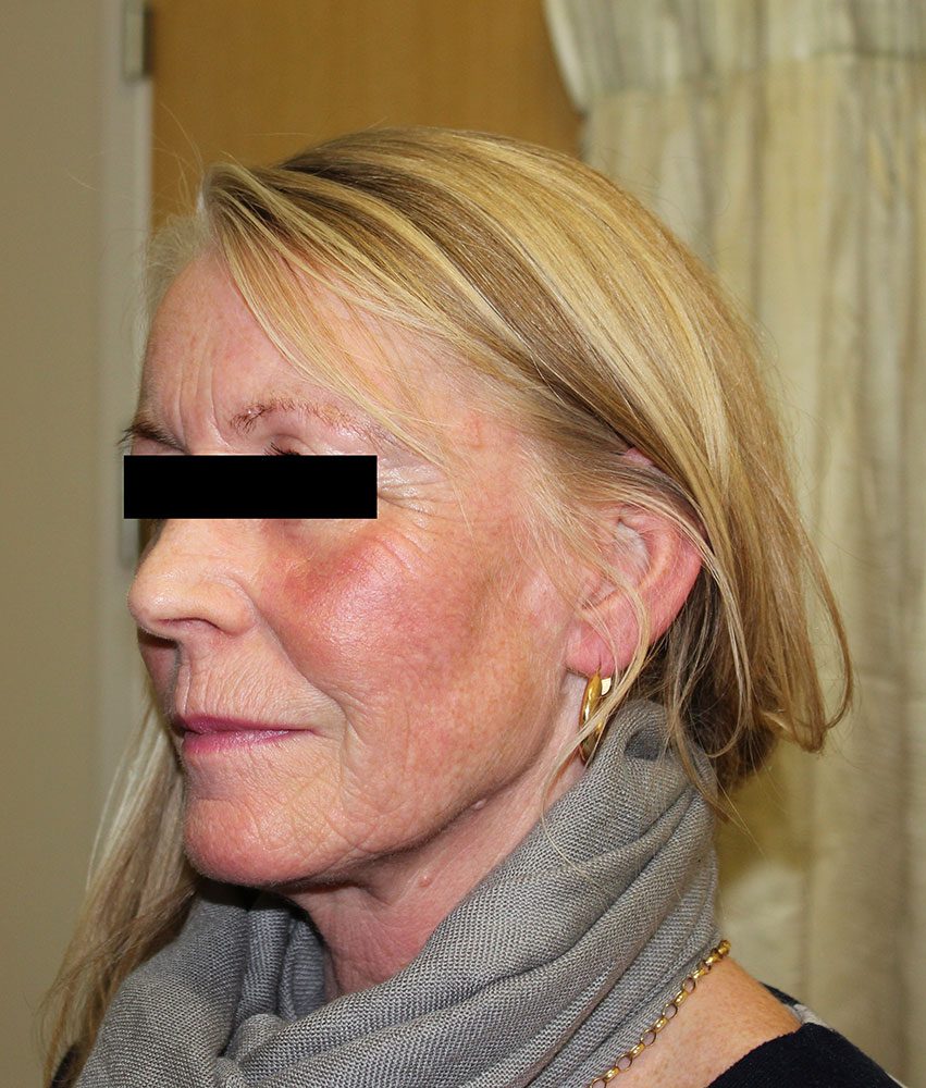 facial fat grafting patient 2 after leftoblique