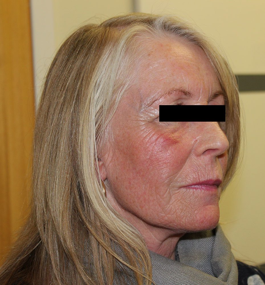 facial fat grafting patient 2 after rightoblique