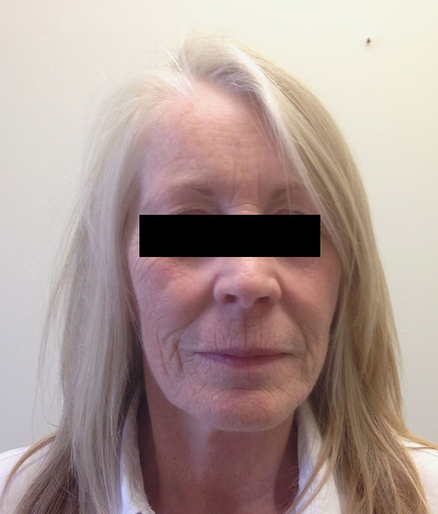 facial fat grafting patient 2 before AP view