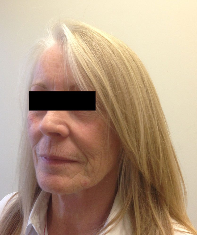 facial fat grafting patient 2 before leftoblique