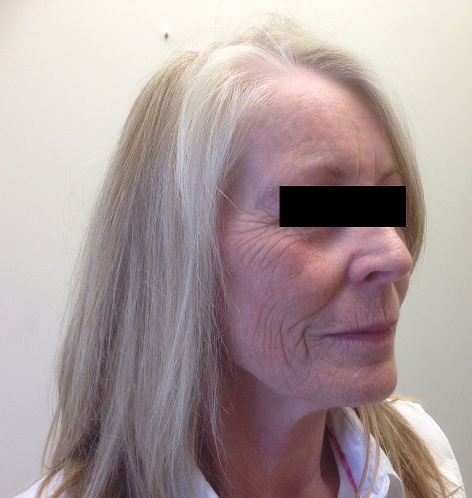 facial fat grafting patient 2 before rightoblique