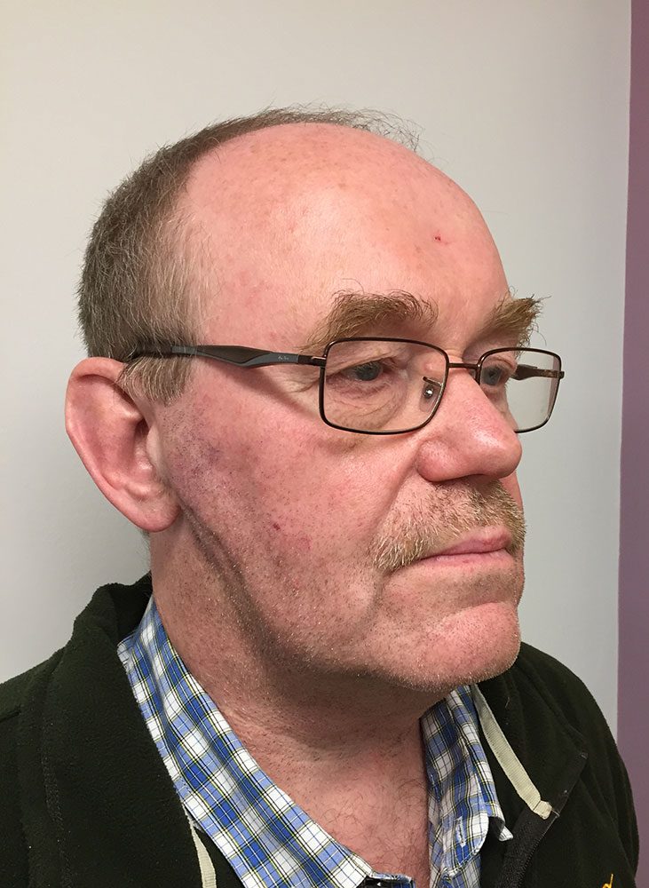 facial lipoma patient 1 after rightoblique