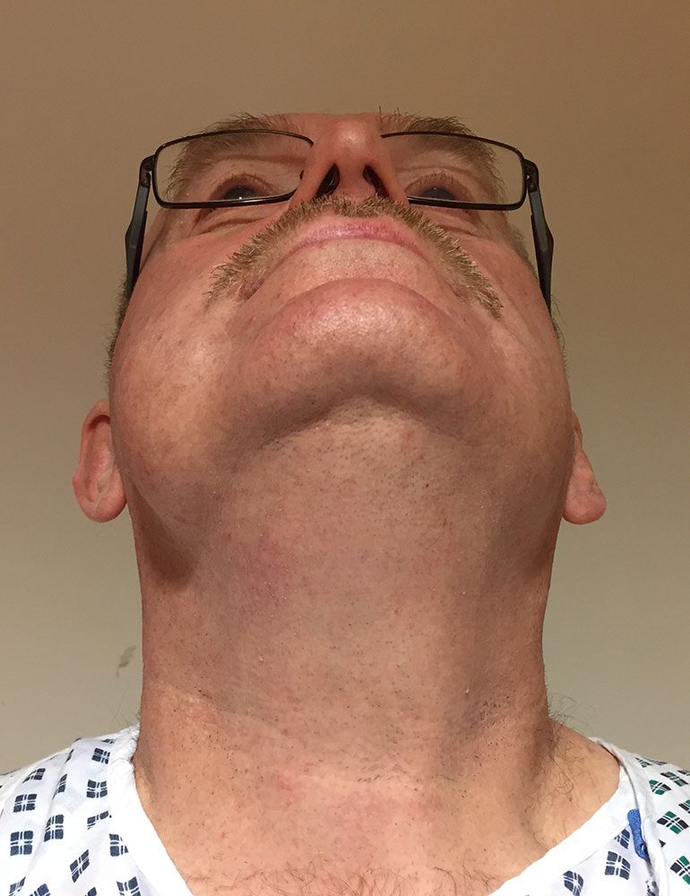 facial lipoma patient 1 before wormseye view
