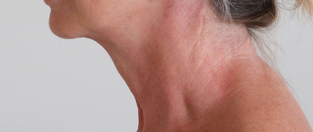 necklift patient 1 after leftlateral