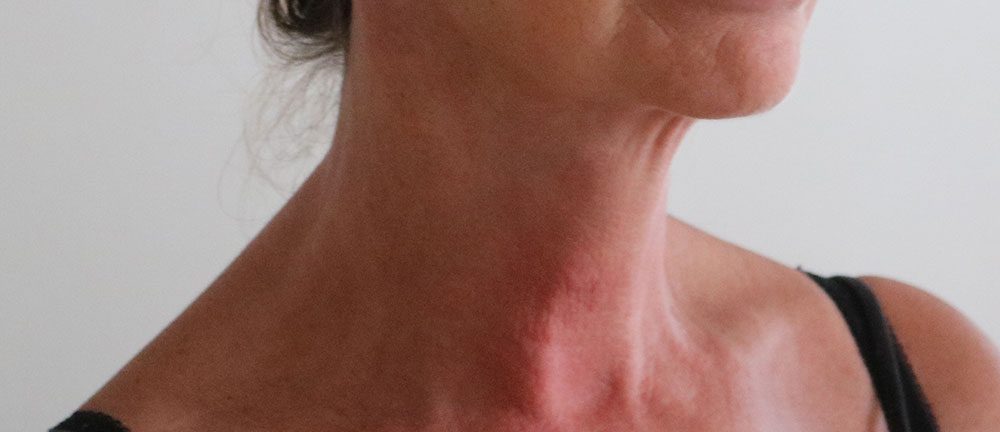 necklift patient 1 after rightoblique