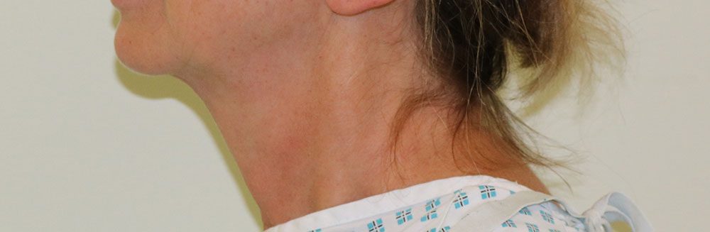 necklift patient 1 before leftlateral
