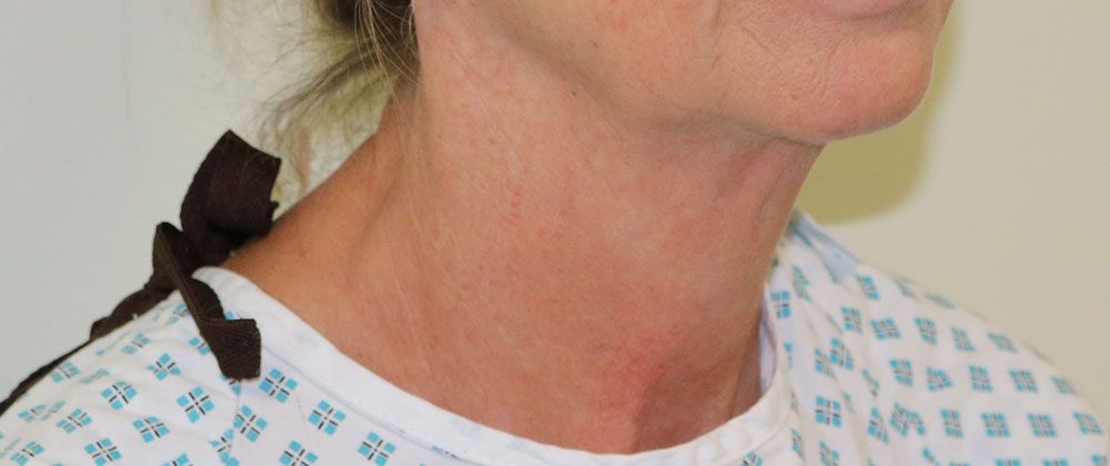 necklift patient 1 before rightoblique
